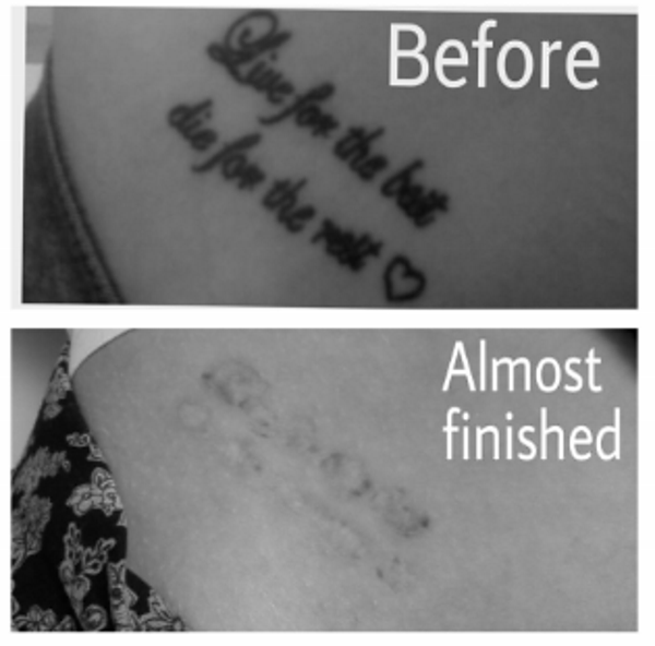 Before and after laser tattoo removal